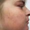 Laserové zákroky estetické dermatologie