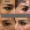 Cirugía de párpados (Blefaroplastia)