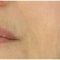 PRP – Plazma terapia (Drakula terapia)