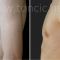 Gynecomastia (Male Breast Reduction)