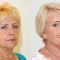 Dermal fillers