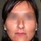 Lipofilling (grasso)