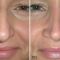 Plastika nosu (Rhinoplastika)