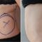 Liposuction
