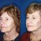Facelift (operace obličeje), SMAS lifting