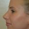 Rhinoplasty (Nose Job)