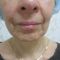 Facelift - 3D kanylové nitě