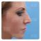 Operácia nosa (Rhinoplastika)