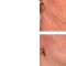 Filler antirughe a base di acido ialuronico