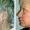 Facelift