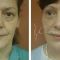 Facelift