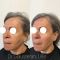 Lifting non chirurgical (Liquid facelift)