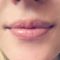 Kwas hialuronowy: Saypha, Restylane, Juvederm, Stylage