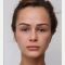 Facelift, SMAS Facelift