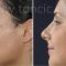 Rhinoplasty (Nose Job)