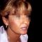 Lip augmentation (fat injection, lipofilling)