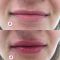 Dermal fillers
