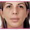 Kwas hialuronowy: Saypha, Restylane, Juvederm, Stylage