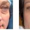Blépharoplastie inférieure