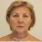 Facelift