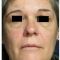 Injections d