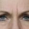 Botulinum toxin - Wrinkle Removal