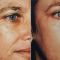 Fractional Laser Resurfacing