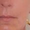 Facelift, SMAS Facelift