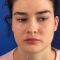 Lip augmentation - cheiloplasty