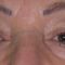 Blépharoplastie