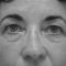 Blépharoplastie