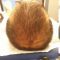 Trapianto capelli