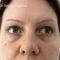 Eyelid surgery (Blepharoplasty)