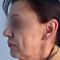 Facelift, SMAS facelifting