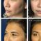 Blépharoplastie