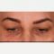 Eyelid surgery (Blepharoplasty)