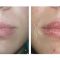 Lip augmentation - cheiloplasty