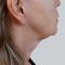 Neck lift