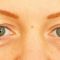 Operácia očných viečok (Blepharoplastika)