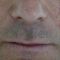 Lip Lift