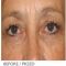 Eyelid surgery (Blepharoplasty)