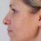 Age Spots Treatment