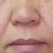 Dermabraze