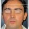 Otoplastie (Chirurgie esthétique des oreilles)