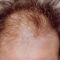 Trapianto capelli
