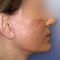 Facelift (operace obličeje), SMAS lifting