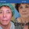 Facelift