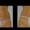 Ultradźwiękowa bezigłowa liposukcja