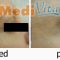 Botulinum toxin - Wrinkle Removal