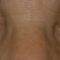 Eyelid surgery (Blepharoplasty)